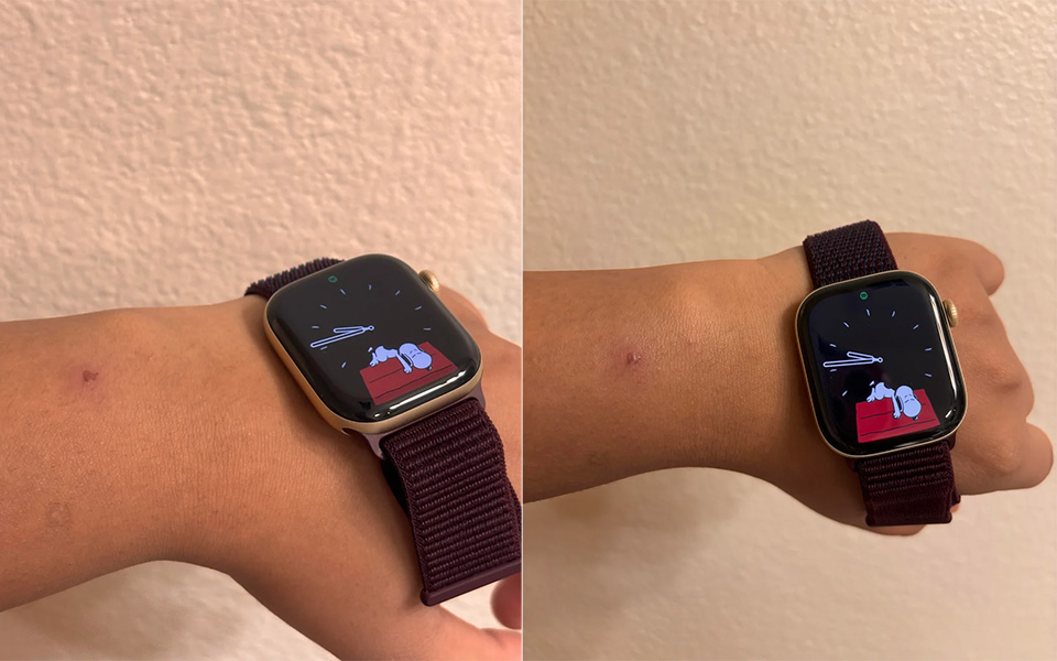 Redness and Apple Watch skin irritation under the Series 12 sensor area